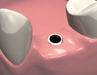 Этапы имплантации зубов - установка имплантата