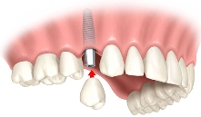Этапы имплантации зубов - протезирование